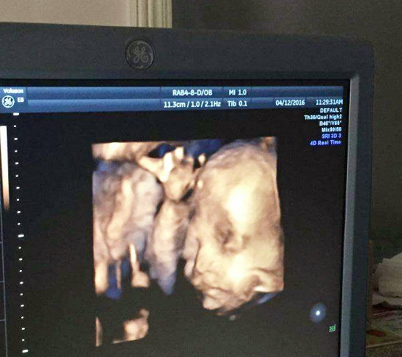 进行|孕期检查多而繁琐，但这几项却不能略过，多花钱总比一无所知要好