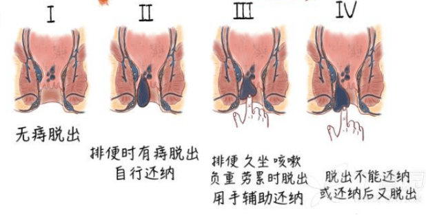 痔瘡的最佳自愈方法_肛門