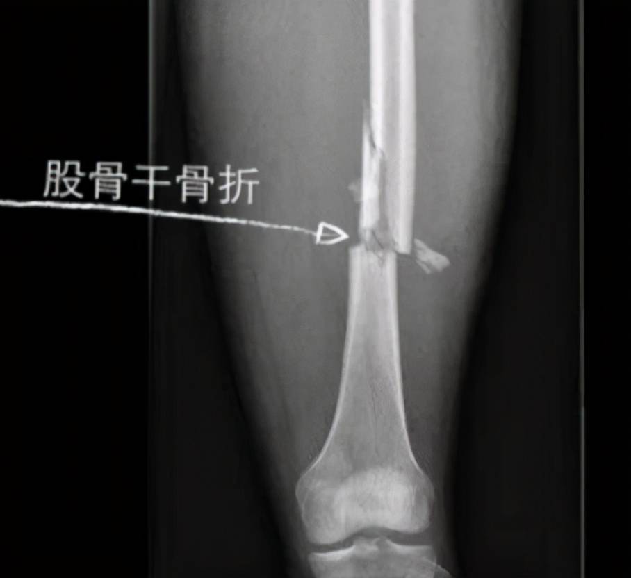 荣大案例 复杂性骨折手术 方案