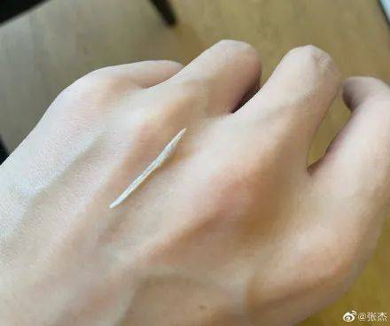 经历|张杰连夜做胃镜麻醉摘鱼骨，炸出一堆“吃鱼困难星人”