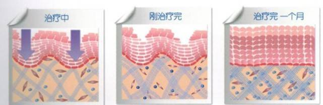 玛吉|攻略：rf射频和热玛吉哪个好？