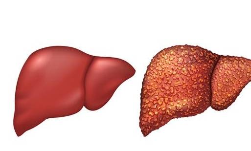 血液|体检出脾肿大,说明有肝硬化?慢性乙肝患者:欲知原因,请看此文