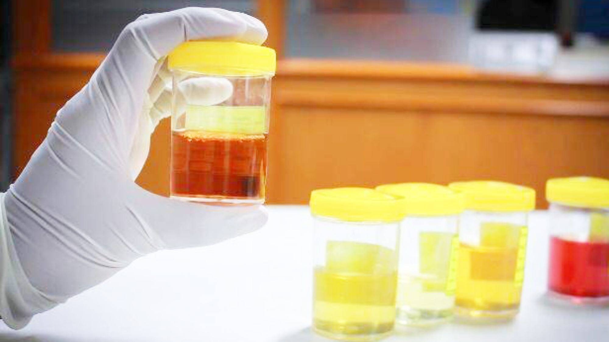 我国|肾病早期毫无感觉，发现已是肾衰竭？远离肾病，带您了解这些知识