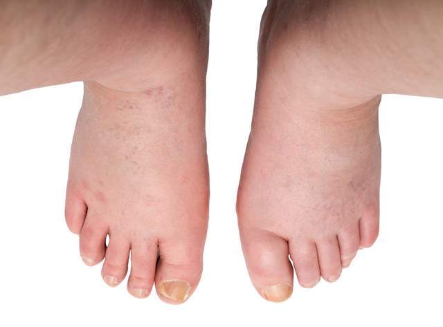 老伯|像肿瘤又不是肿瘤?警惕IgG4相关性疾病!前海人寿广州总医院科普