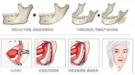 要求|骨相美可遇不可求，伤筋动骨需谨慎！！！