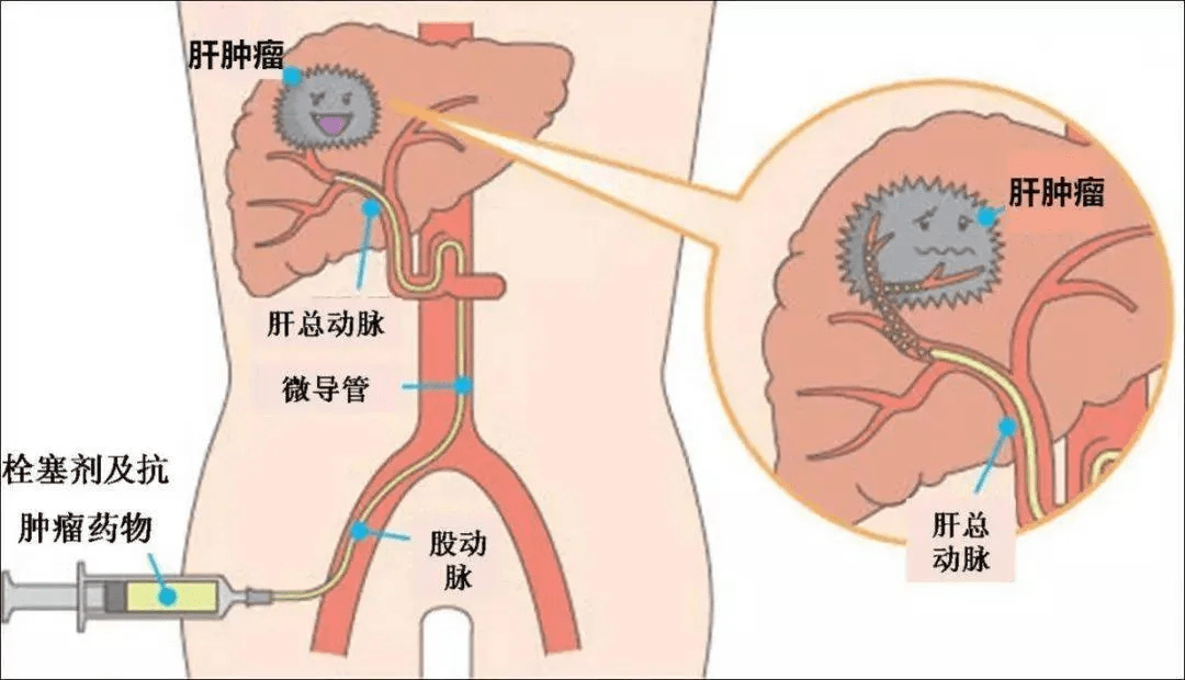 延长肝癌患者生存的一线治疗方案经动脉化疗栓塞联合索拉非尼