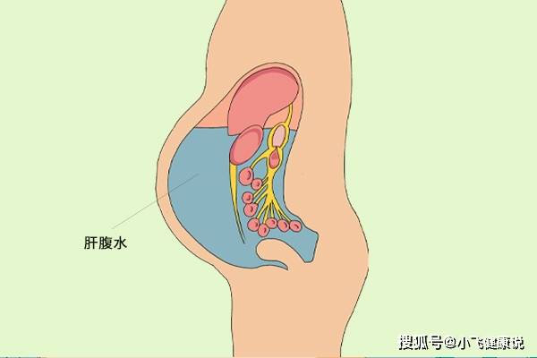治療|肝若硬化了，前2個月身體一般就有提示，別等拖到晚期才后知后覺