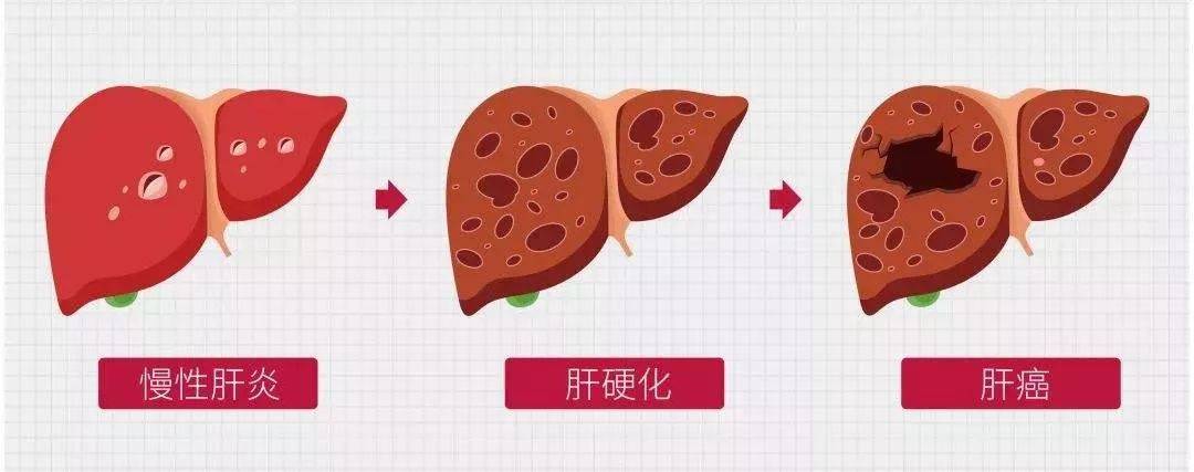 加重负担|大叔乙肝3年转阴，坚持做好3件事，肝病或靠边站