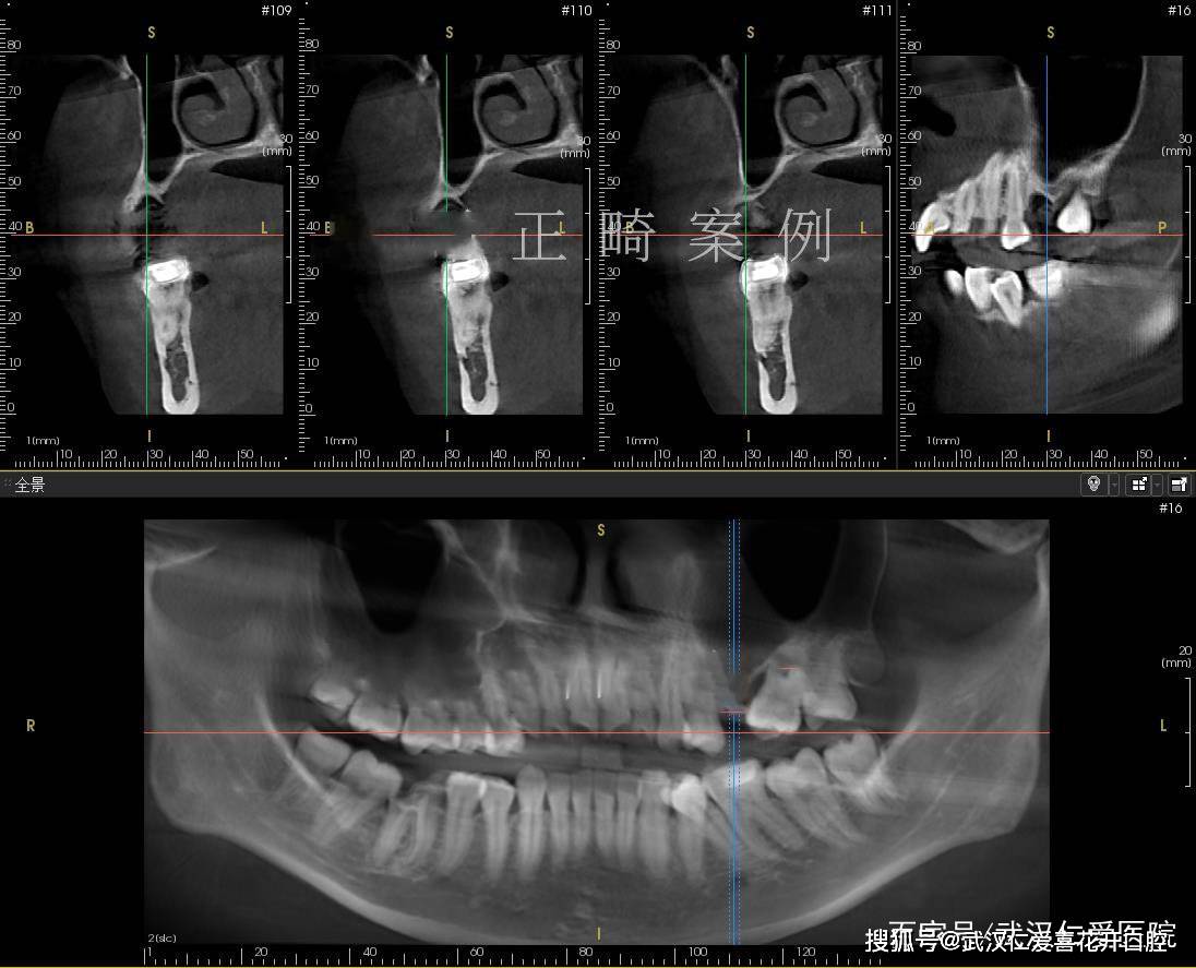 武汉仁爱口腔 牙列拥挤,牙槽骨严重吸收案例