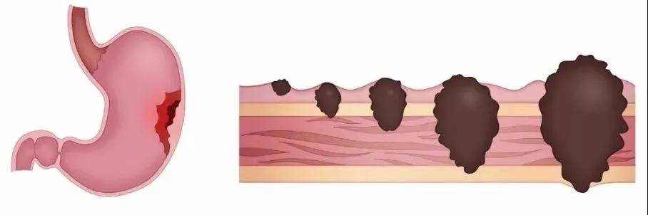 识别|对照看你是胃癌高危人群么？如何识别胃癌早期信号?