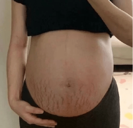 地方|肚皮长妊娠纹不美观！孕期做好这几点，基本就妥了，准妈妈看过