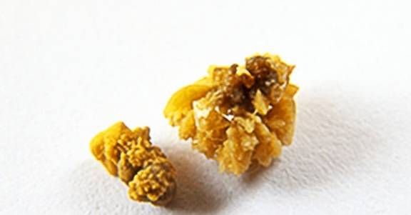 治疗|肾结石,真的可以自己排出来吗?你或许真的不知道,看专家的理解