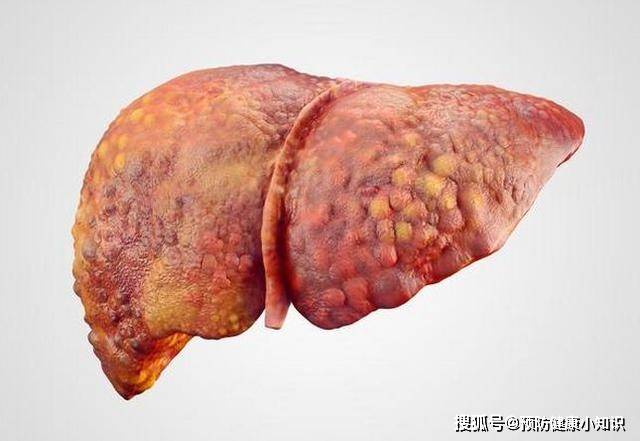 肝脏|肝硬化是否跟喝酒有关？医生：冰箱中2样食物更伤肝，不妨了解