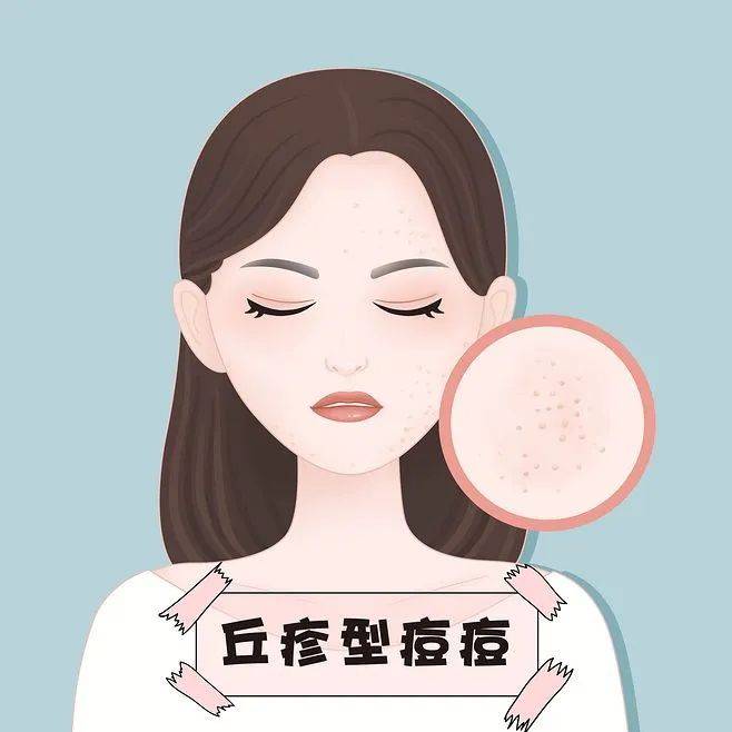 方法|各种长痘的原因，你知道吗？