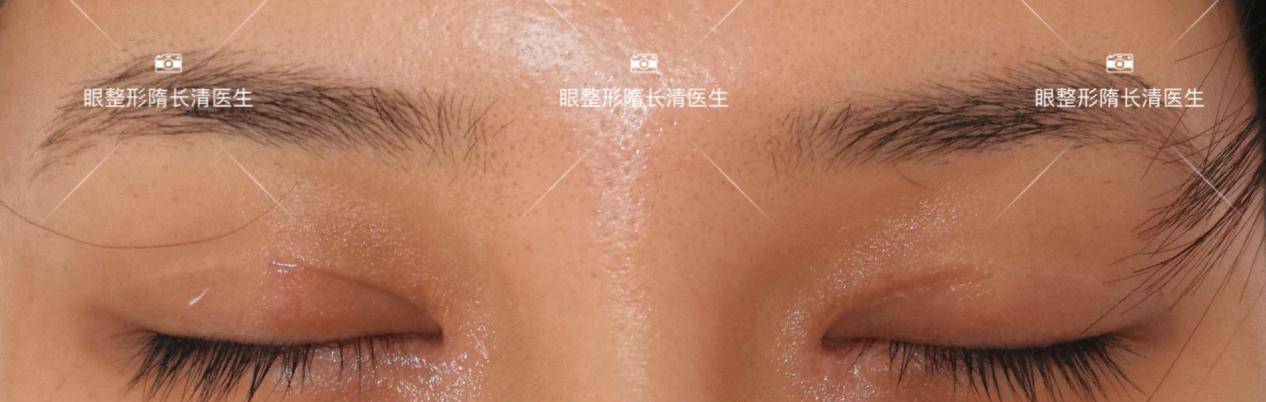 面的|她跟戚薇一样,做完双眼皮修复都变美了!