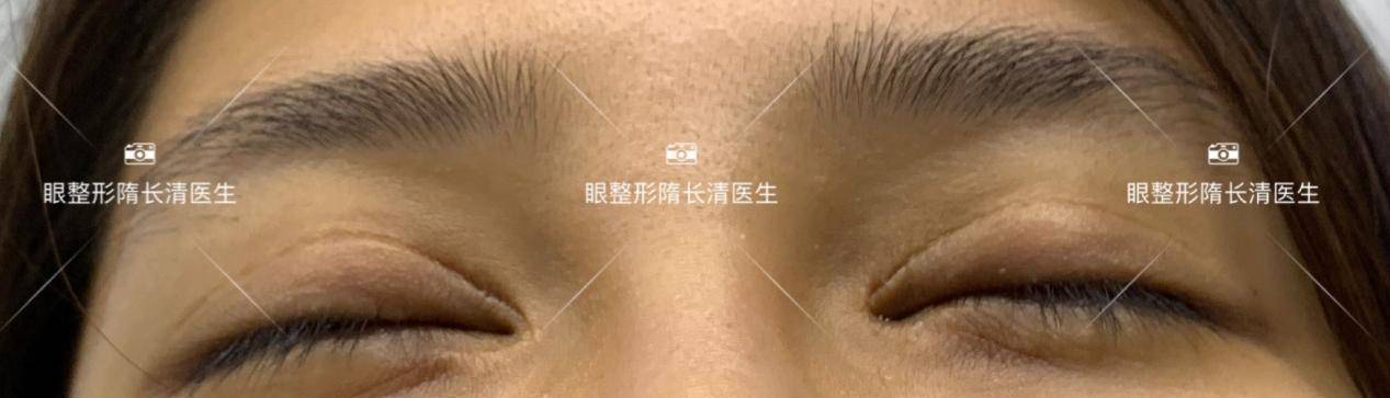 面的|她跟戚薇一样,做完双眼皮修复都变美了!
