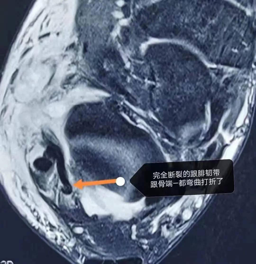 微信|踝關節扭傷，骨頭沒事就真的沒事嗎？——外踝副韌帶斷裂是最容易漏診的“鬼”