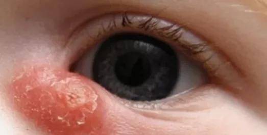 这种先天性眼病,极易拖成泪囊炎！娃眼屎多是第一征兆！