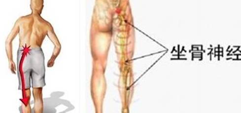 什么是坐骨神经病 b9475a0df5164ee6bd3460f2fb506177.jpeg