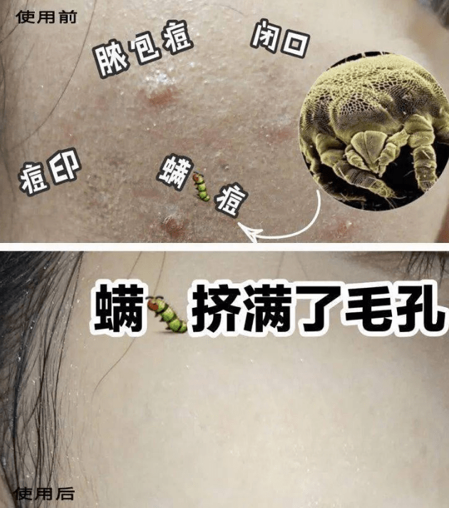 方法|脸上长痘痘的原因？怎么去痘痘的方法最快最简单（美容师分享）