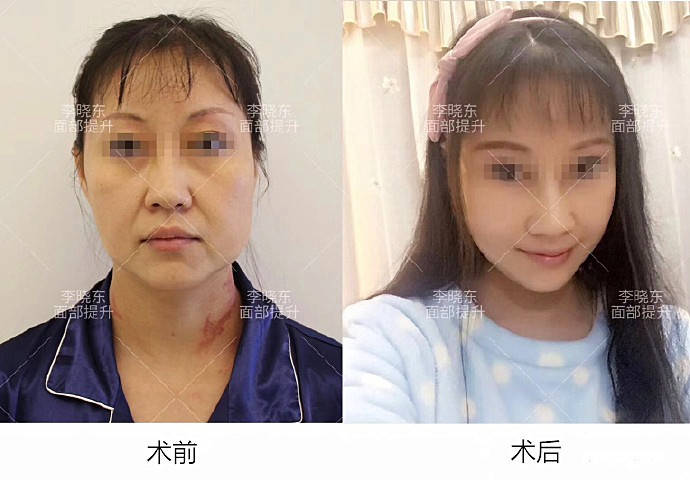 什么|面部抗衰 线雕适合哪些人做？禁忌是什么？线雕修复有多难？