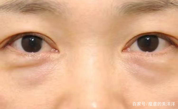 眼睛|有眼袋，20岁的小仙女也会被拖累成老阿姨！