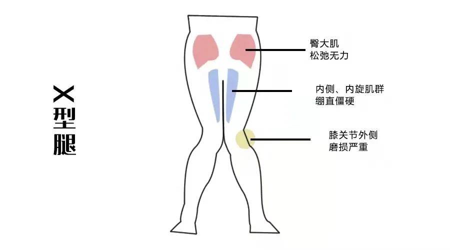 活了二十几年你才告诉我,我的x型腿是自己硬掰出来的?