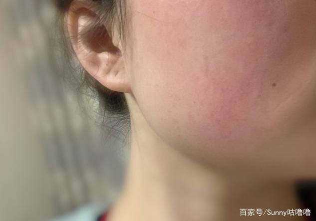 产品|还买这“三类成分”的护肤品？孕期上脸就过敏，第一个大家都用过