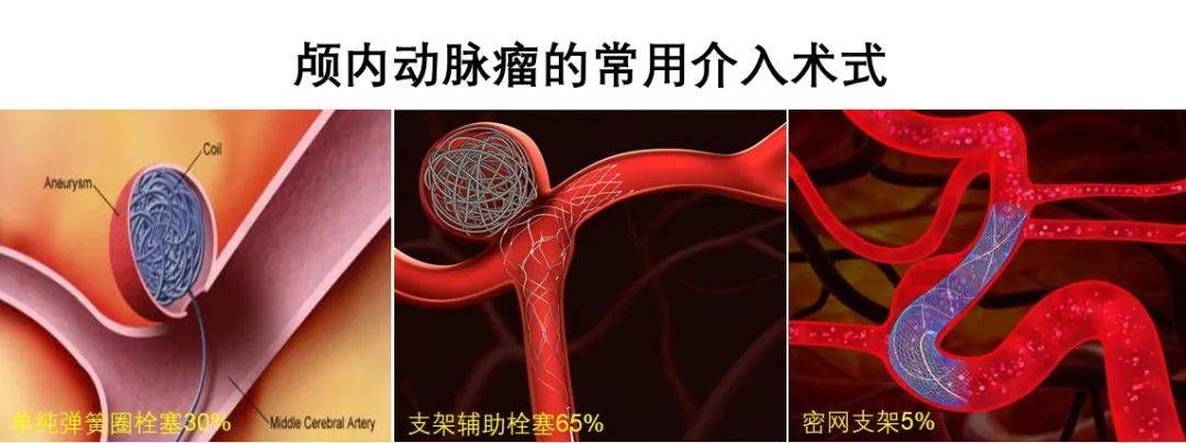 栓塞|颅内动脉瘤的手术治疗有哪些？