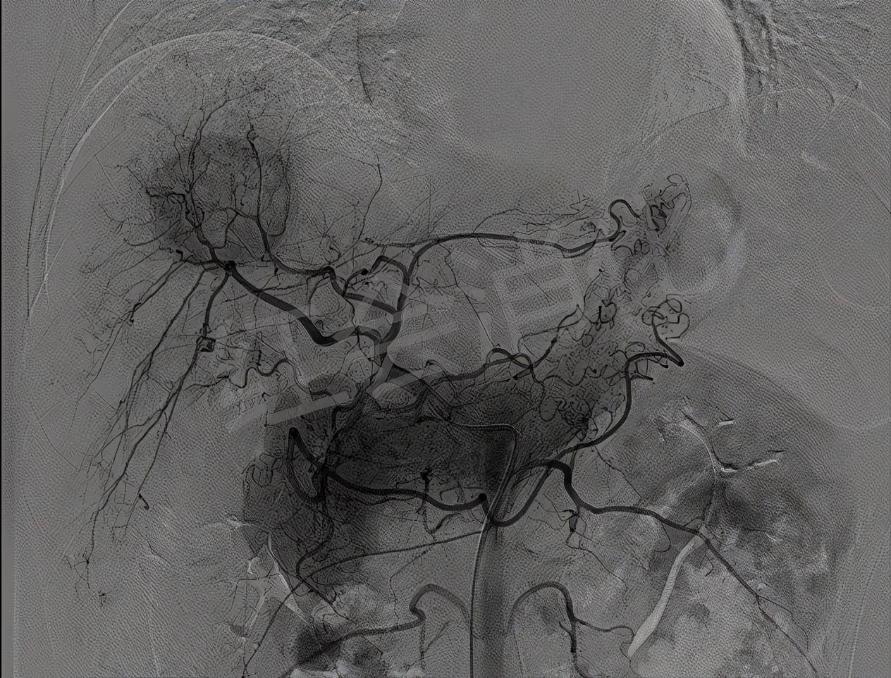 血管|西安市红会医院 让肿瘤“饿”死的TACE术 为两例中晚期肝癌排忧