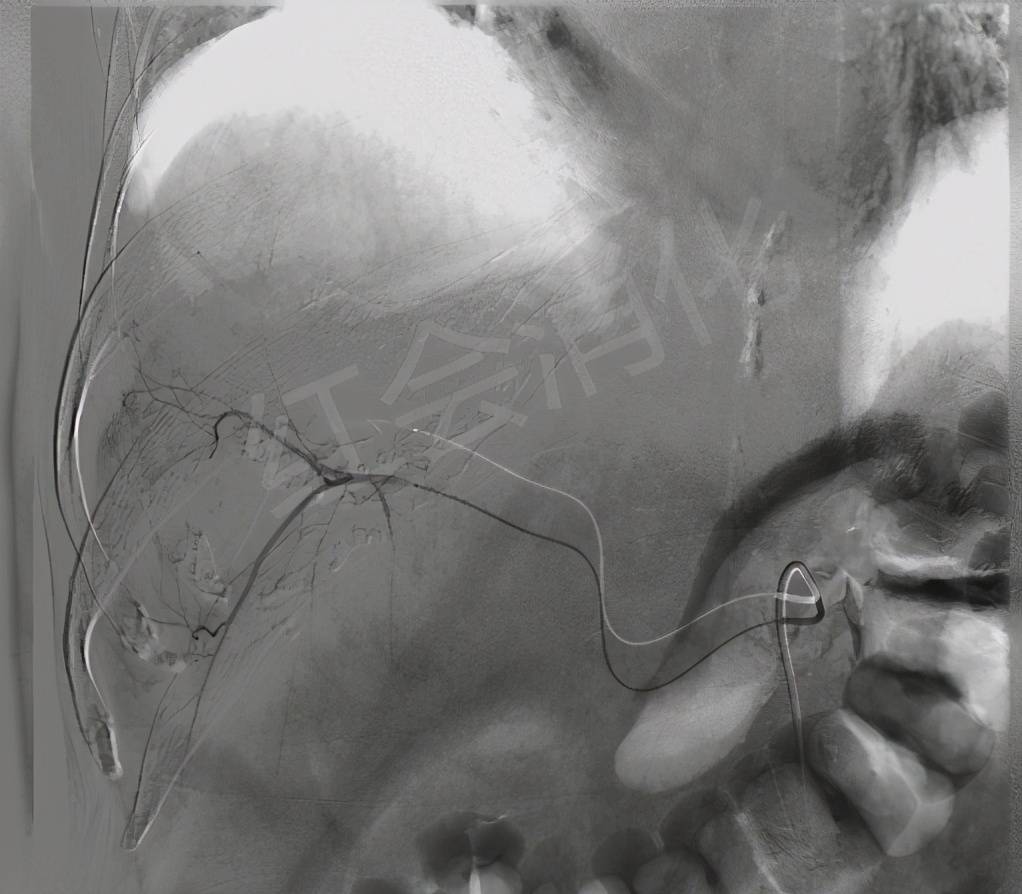 血管|西安市红会医院 让肿瘤“饿”死的TACE术 为两例中晚期肝癌排忧
