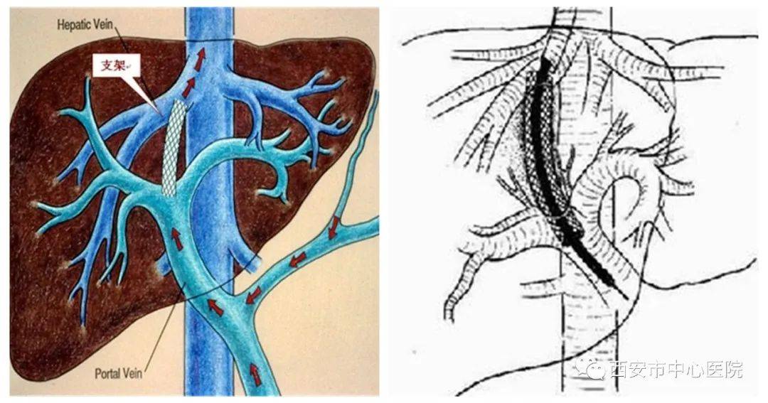 团队|西安市中心医院消化病院介入团队成功完成TIPSS手术