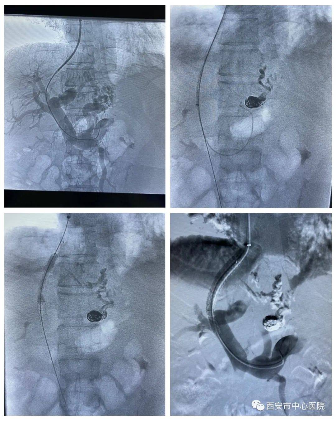 团队|西安市中心医院消化病院介入团队成功完成TIPSS手术