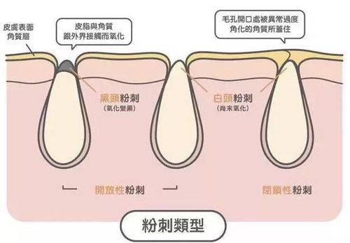 因为|爆痘急救手册，逆袭苹果肌