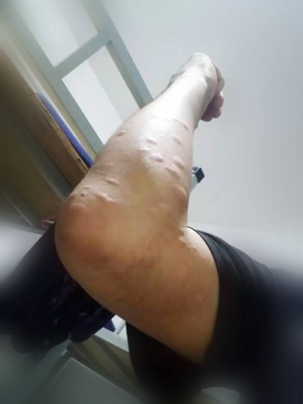 保山移民管理警察被蚊虫叮咬红肿的照片,让多少人心疼动容