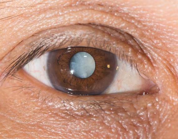 白内障的主要症状是什么?烟台正大光明眼科医生告诉你!