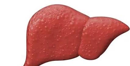 肝脏|假如你有乙肝，可能会问：肝硬化能“逆转”吗？听听医生怎么说！