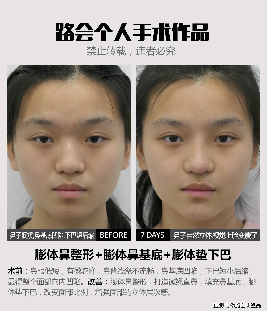 个人|鼻整形手术,到底是局麻好?还是全麻好?