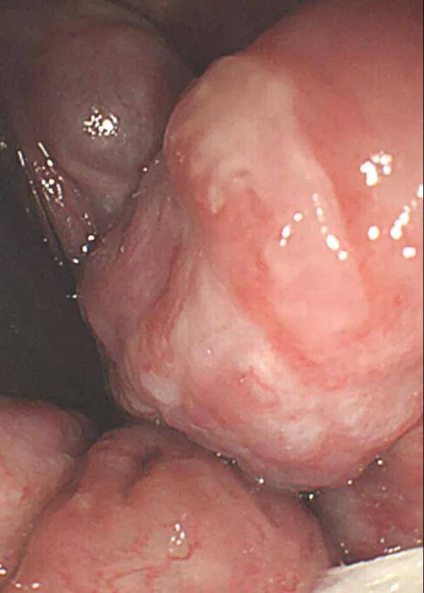 肛门口|20岁小伙因痔疮致贫血 近乎失了全身2/3血量