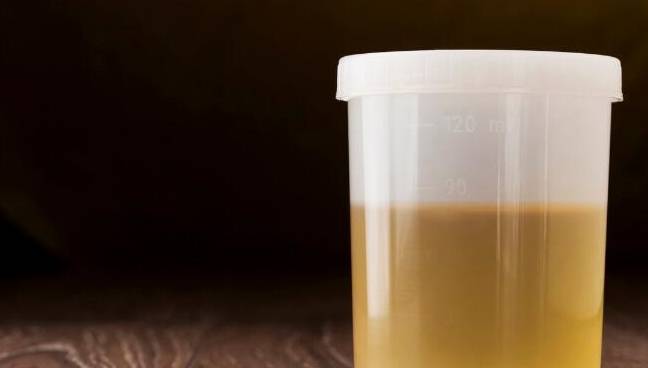 尿液|肾病好转，4项尿液指标会发信号，若都有先恭喜你