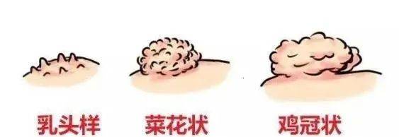 分泌物|尖锐湿疣早期冒小白点吗?