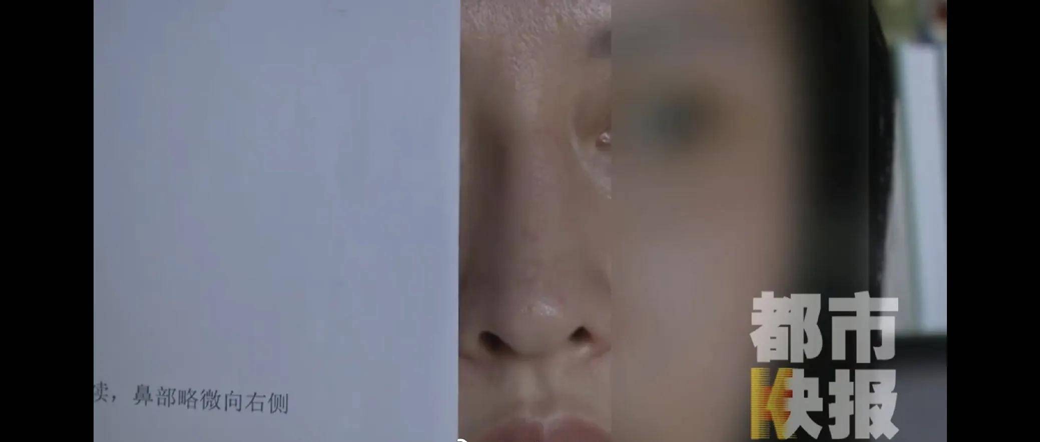 女子花9万在西安美莱医学整容医院做手术后鼻子歪了(图9)