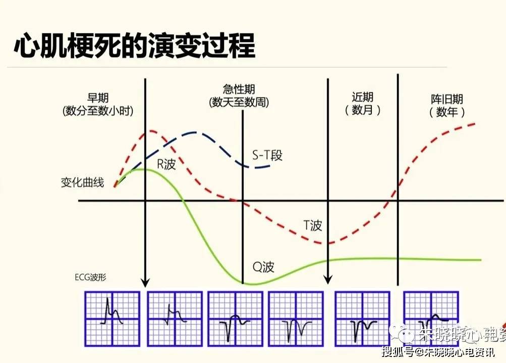 经典的心肌梗死心电图分期:超急性损伤期,急性期,演变期(进展期)和