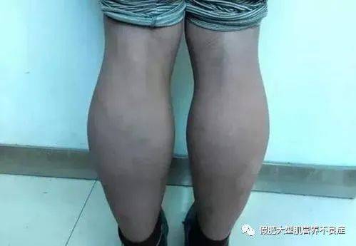 退行性|肌营养不良,危害健康肌肉的“病魔”