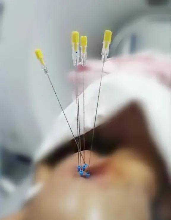 肿瘤|咸阳市中心医院开展不开刀颅内肿瘤放射性粒子植入术