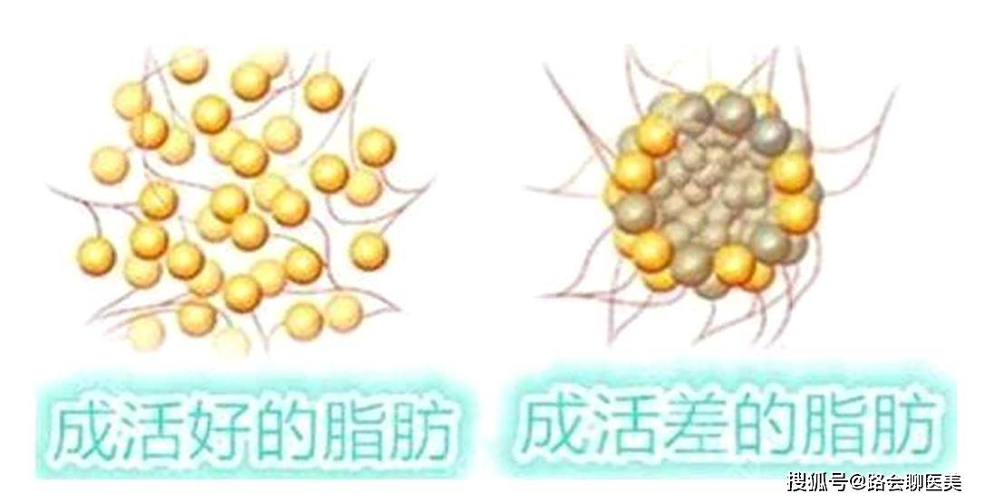 面部|为什么说年龄越大，越不建议做脂肪填充？(1) 头条文章