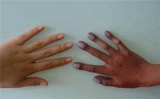 症状|怎样发现患有间质性肺炎？间质性肺炎如何治疗？