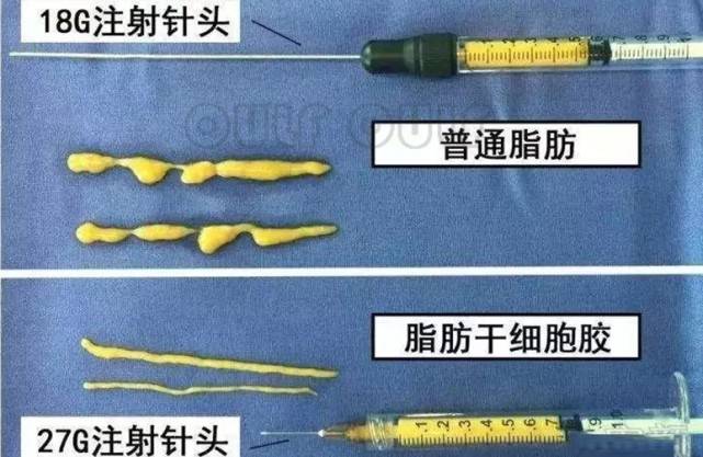 脸部|脂肪胶填充脸部可以维持多久？面部脂肪胶填充能管多久？想知道的看看