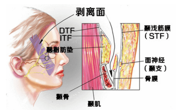 蛋白|筋膜提拉术是什么？面部筋膜提升术的危害大不大？细细品！