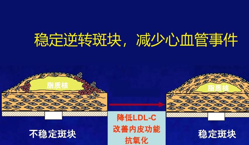 血管|动脉粥样硬化后,降脂药要服多久?血脂正常了还需要继续服药么